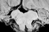 Dorsolateral medullary infarct